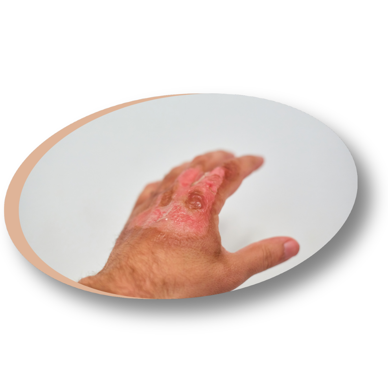 Magnétiseur coupeur de feu à Lunéville pour soulager les brûlures et douleurs vives.